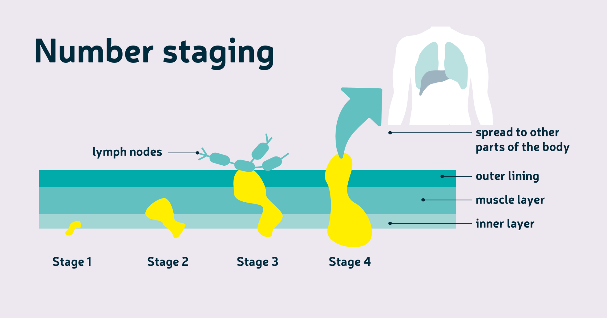 Staging and Grading - Copy.png